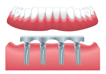 Implant Supported Dentures in Huntingburg, IN