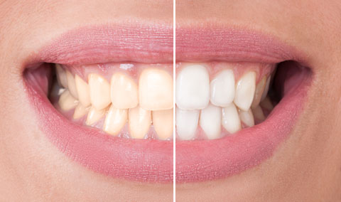 Teeth Whitening in Huntingburg, IN