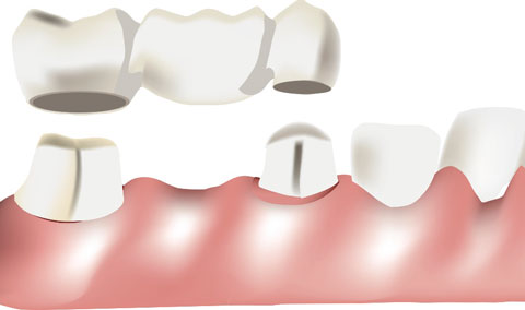 Porcelain Crowns and Bridges in Huntingburg, IN