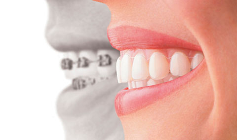 Invisalign Clear Braces in Huntingburg, IN