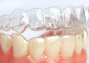 The Benefits of Invisalign