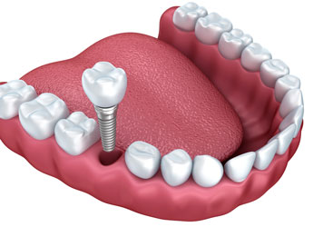Dental Implants in Huntingburg, IN